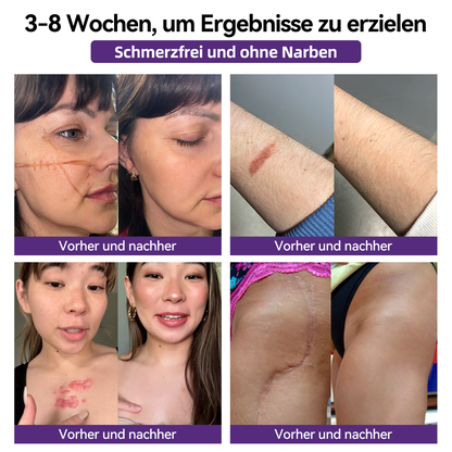 [ 𝐎𝐟𝐟𝐢𝐜𝐢𝐚𝐥 𝐒𝐭𝐨𝐫𝐞 ]  𝖹𝖮𝖤𝖭𝖢𝖦𝖹® Fortschrittliches Narbengel  Dermatologen-Empfehlungen