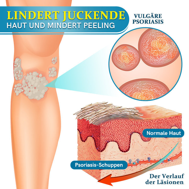 Tnnedey™ 🩵🌿Multi-Symptom Psoriasis-Behandlungcreme (👨‍⚕ Ärztlich empfohlen)