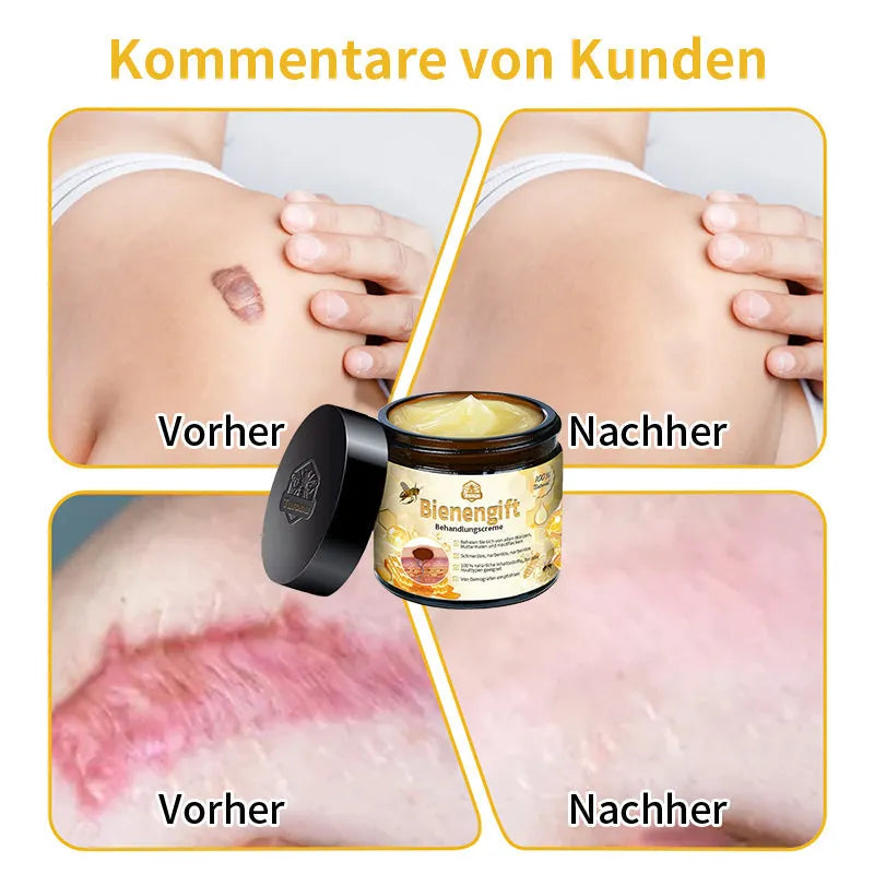 [Herbst-Hautpflege] 𝐓𝐧𝐧𝐞𝐝𝐞𝐲 Bienengift-Hautpflegecreme (AAD Empfohlen) 👨‍⚕️(Letzte Tag Promotion, 80% Rabatt)