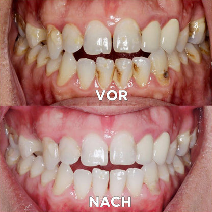 ✅BMEL-Zulassung |Yovot™ Kokosöl-Mundspülung mit ätherischem Öl