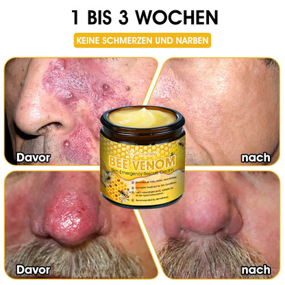 Tnnedey™ Bienengift Haut-Notfall-Rettungscreme (AAD empfohlen) 💆‍♀️ (Expertenempfehlung)