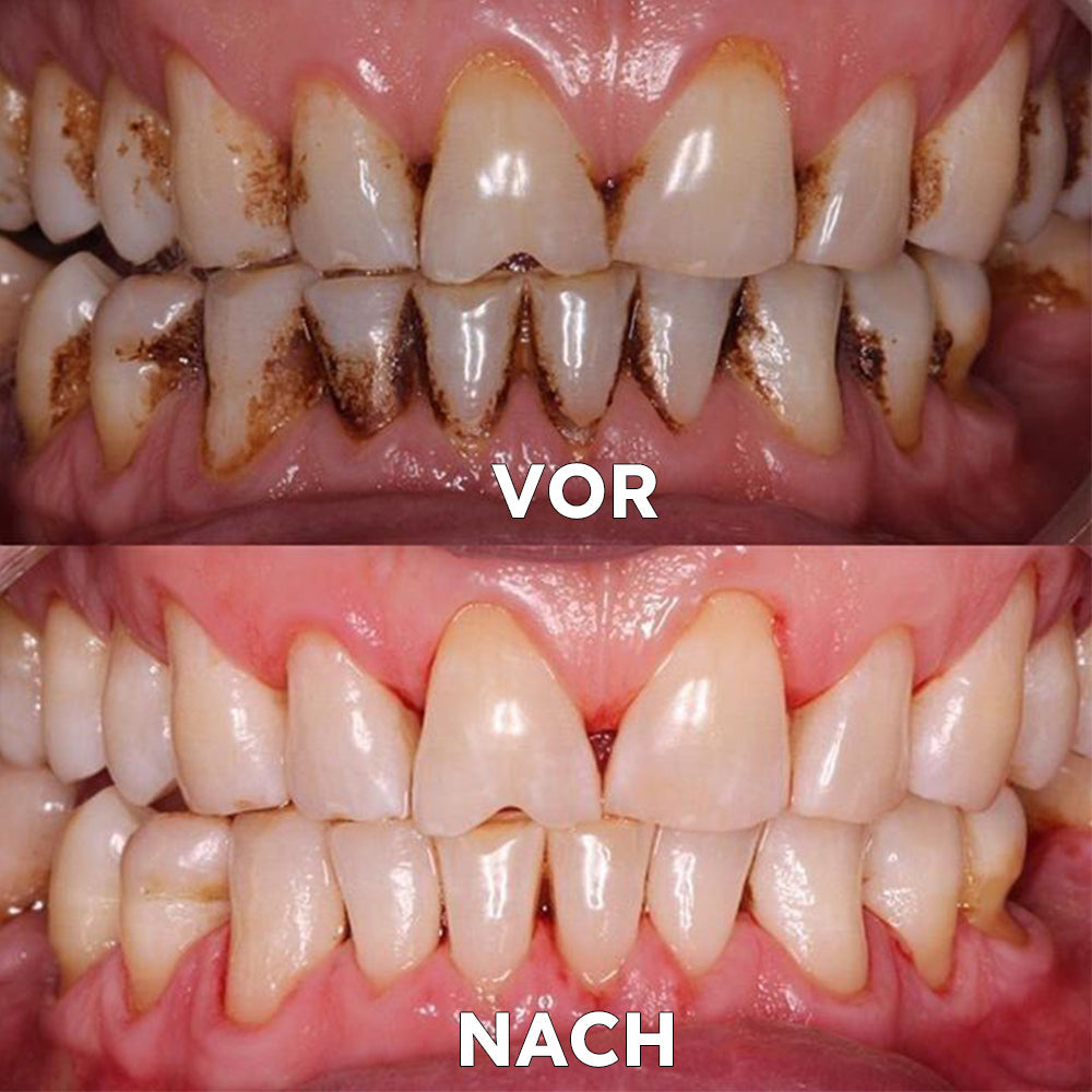 ✅BMEL-Zulassung |Yovot™ Kokosöl-Mundspülung mit ätherischem Öl