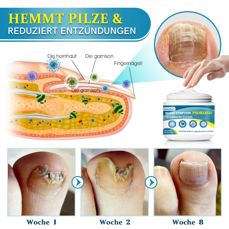 Tnnedey™ 🩵🌿Multi-Symptom Psoriasis-Behandlungcreme (👨‍⚕ Ärztlich empfohlen)