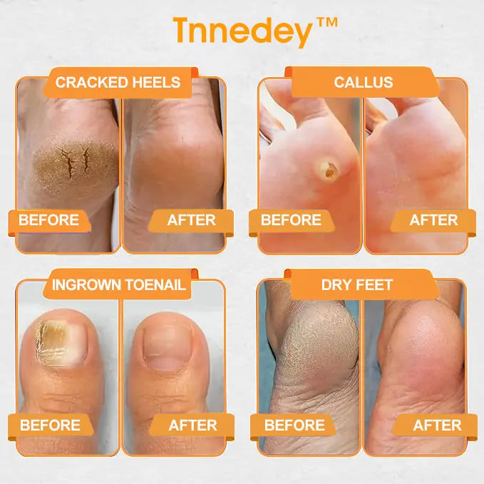 Tnnedey™ Bienenvenom Lymphatische Drainage & Schlankheits-Fußpflaster – Zielgerichtete Schwellungen & Natürliche Entgiftung 🌿👣