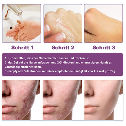 [ 𝐎𝐟𝐟𝐢𝐜𝐢𝐚𝐥 𝐒𝐭𝐨𝐫𝐞 ]  𝖹𝖮𝖤𝖭𝖢𝖦𝖹® Fortschrittliches Narbengel  Dermatologen-Empfehlungen