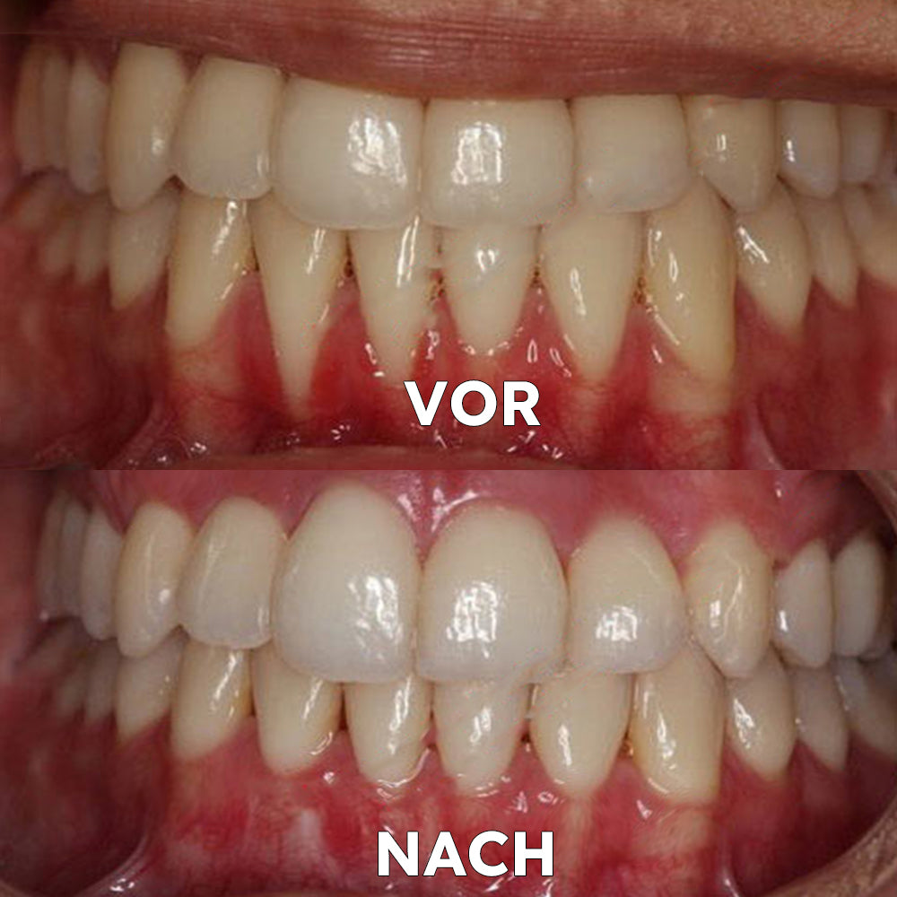 ✅BMEL-Zulassung |Yovot™ Kokosöl-Mundspülung mit ätherischem Öl