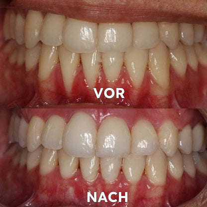 ✅BMEL-Zulassung |Yovot™ Kokosöl-Mundspülung mit ätherischem Öl