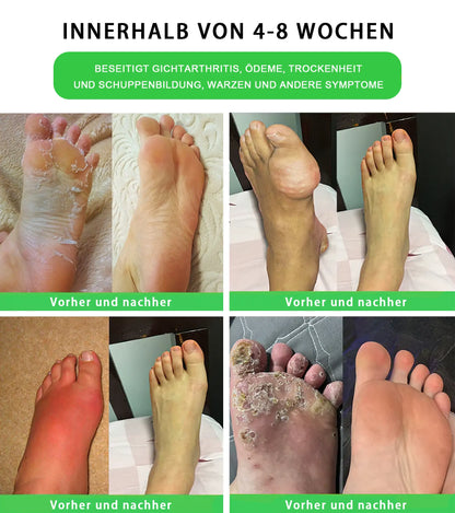 Tnnedey® 30 Kräuterstraffende Schlankheits- & Detox-Fußbadkugeln 🌿✨ - Effektive Behandlung für hohen Blutzucker 💉 und Arthritis 🦶💪